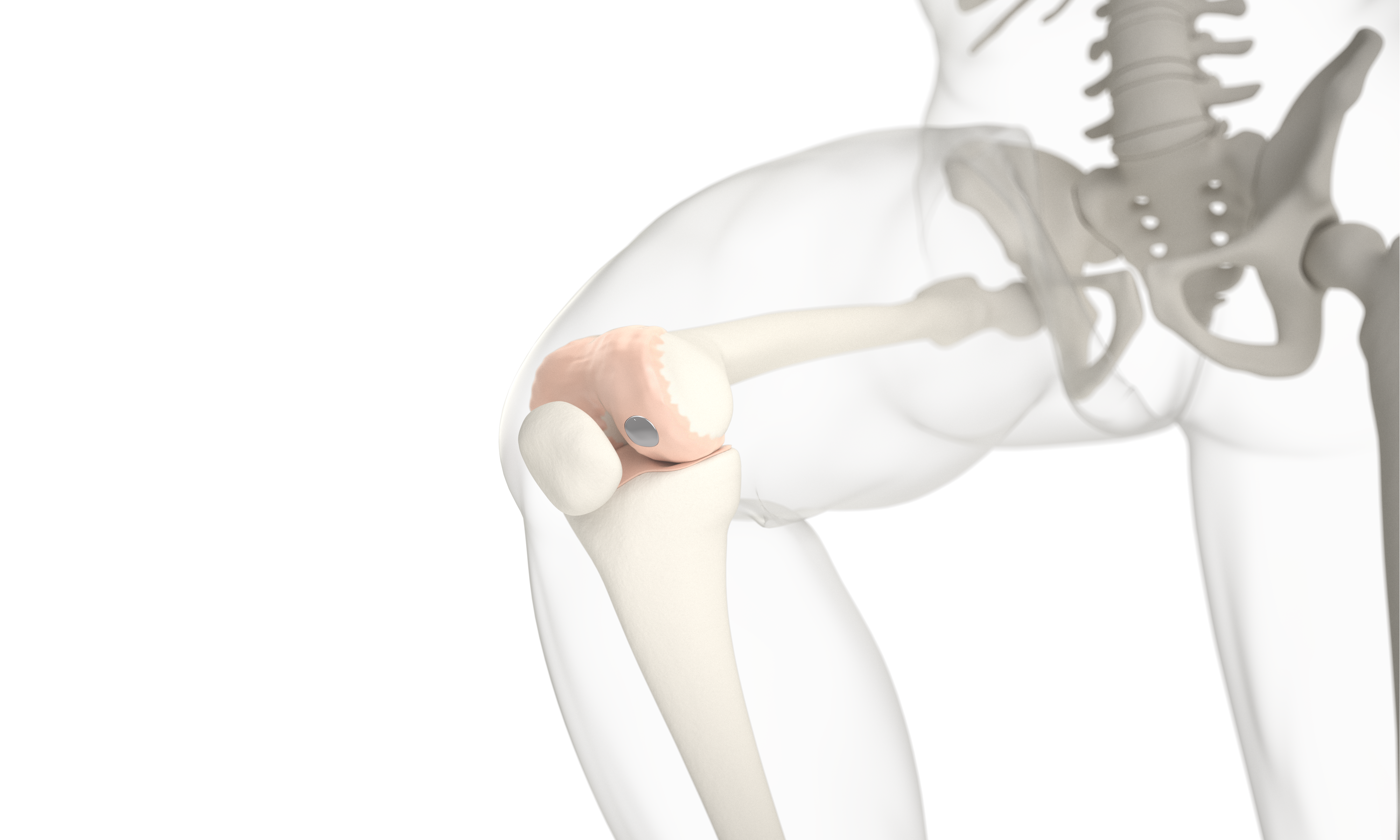 Episurf Medical AB